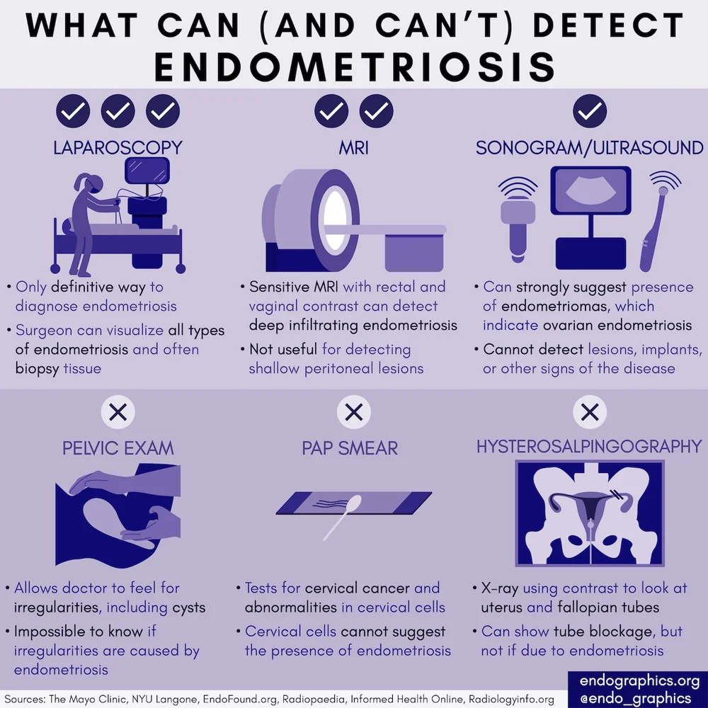 What can and can’t detect endometriosis. Infographic on laparoscopy, MRI, ultrasound, pelvic exam, Pap smear, and hysterosalpingography
