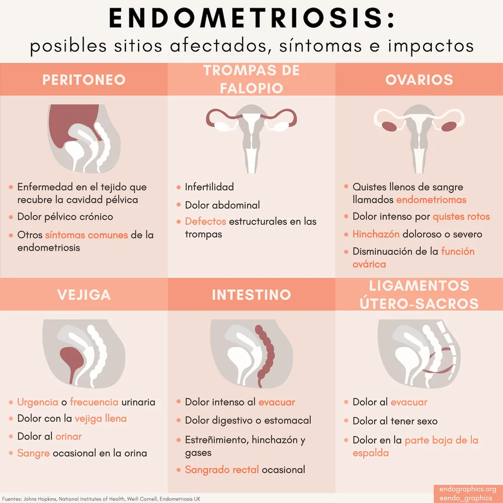 Endometriosis: posibles sitios afectados, síntomas e impactos. Infografía