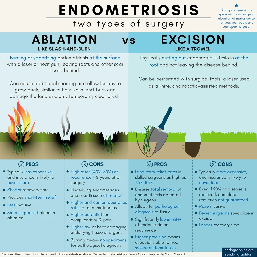 Endometriosis: two types of surgery. Infographic comparing ablation with excision