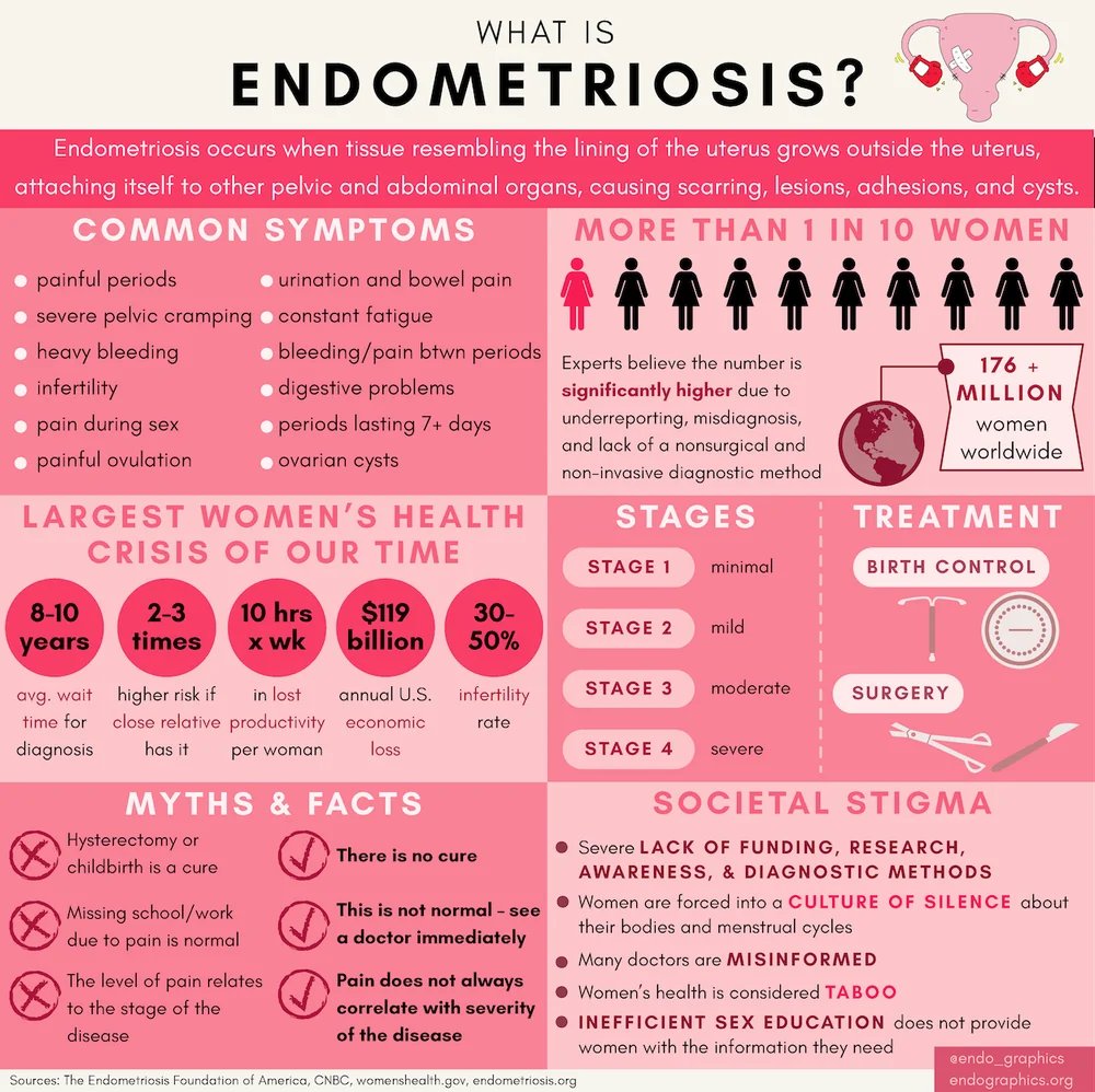 What is endometriosis? Infographic on common symptoms, how many women are affected, stages, and treatment